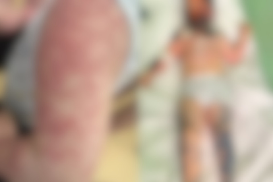 Последствия болезни - пятна покрыли практичесики все тело малыша