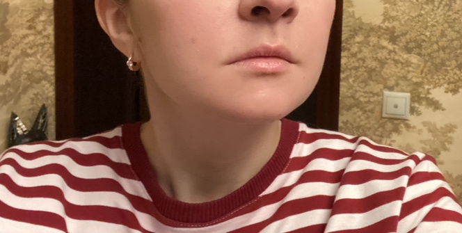 Конец первых суток после операции - начинает формироваться отёк