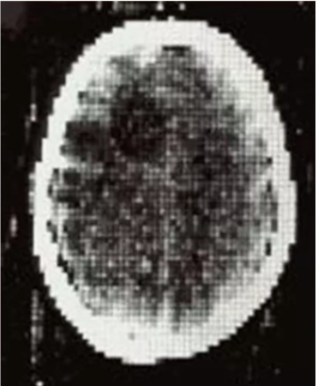 Самый первый в мире аксиальный  срез головного мозга у пациента с опуххолью. 