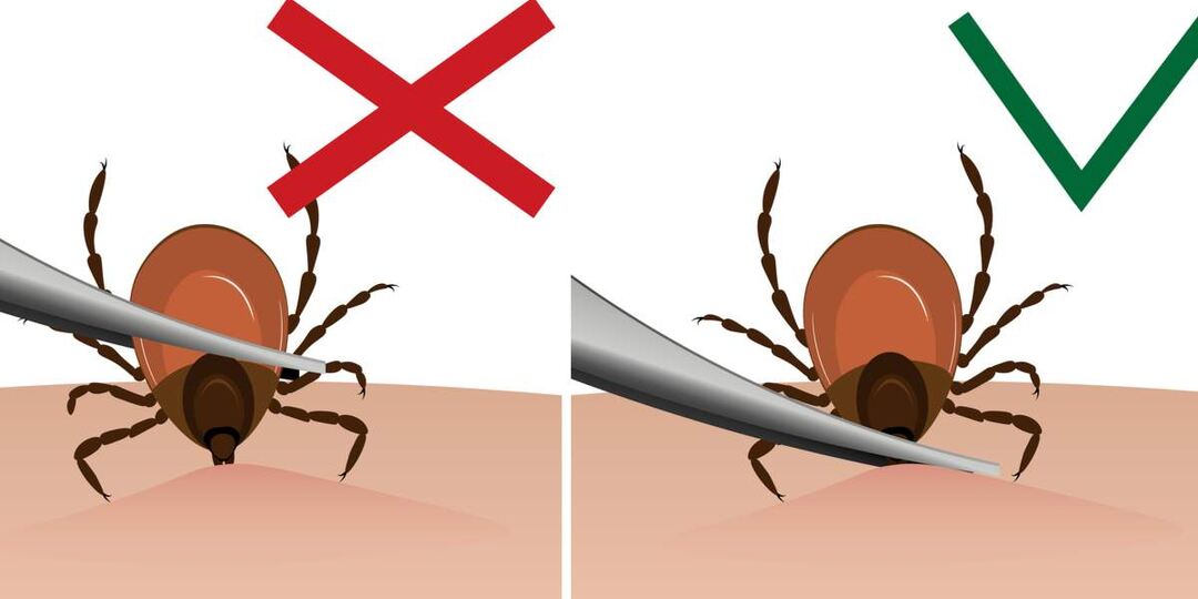 Клещей снимают неправильно — и это дорого обходится