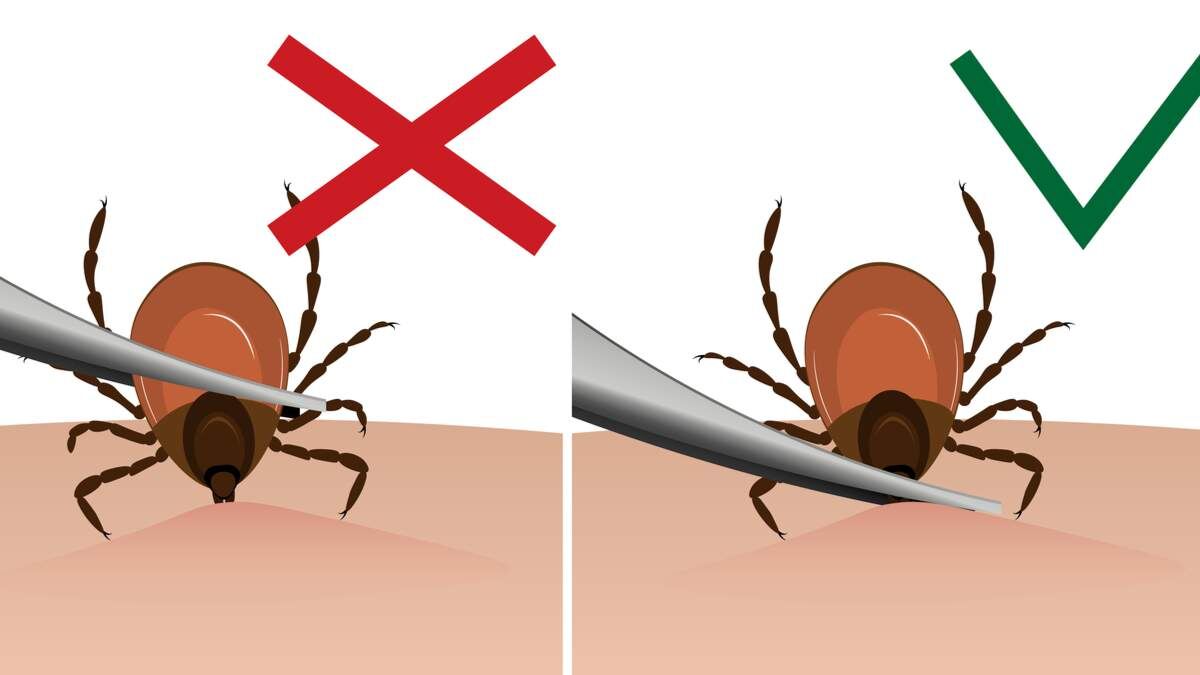 Клещей снимают неправильно — и это дорого обходится вашему здоровью!