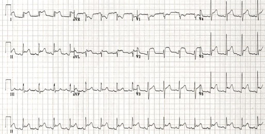 перикардит - диффузные подъемы ST почти во всех отведениях