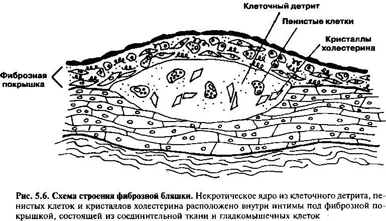 Из чего состоит бляшка и что с ней делать?