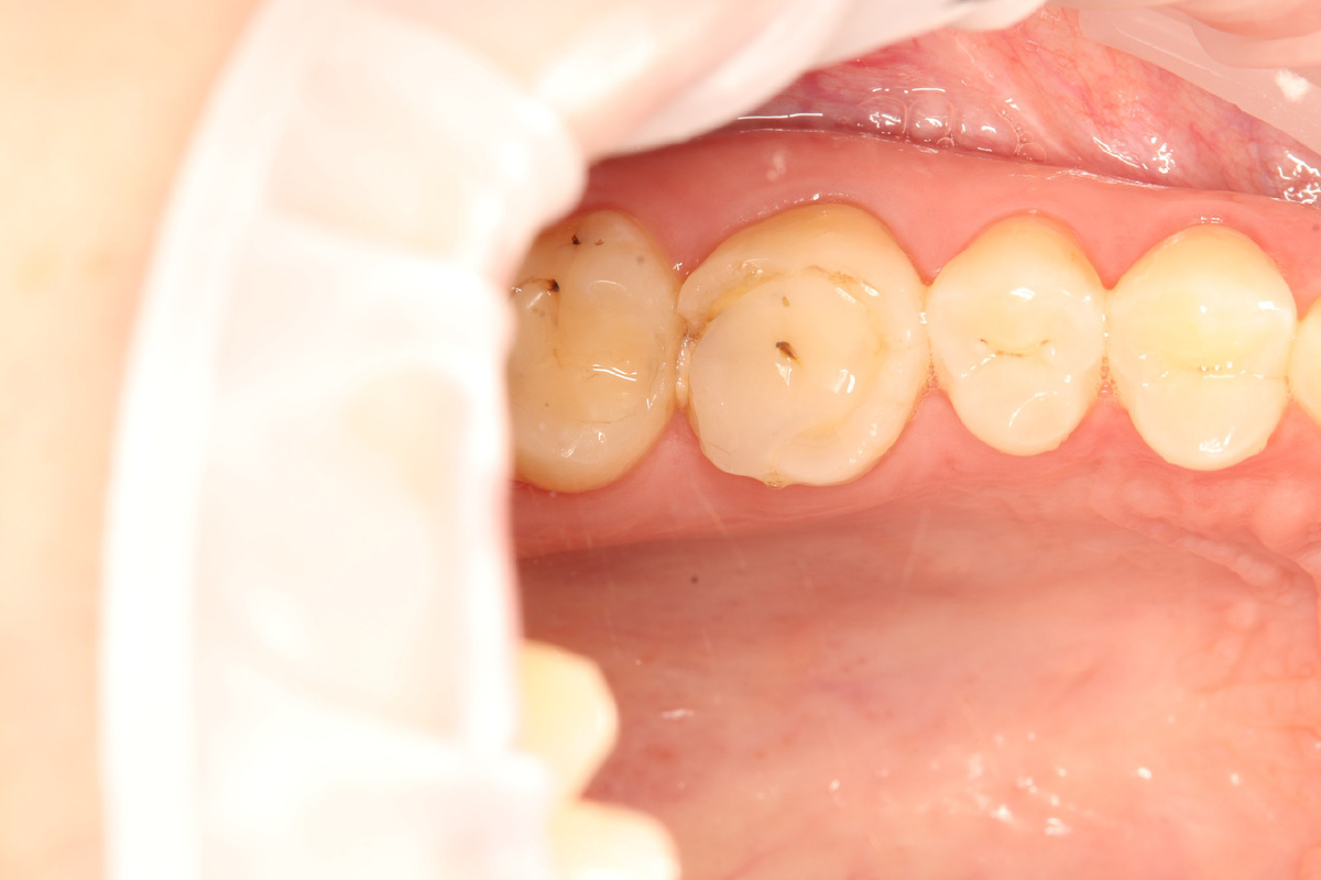 Старые пломбы, которые теряют со временем свои полезные свойства