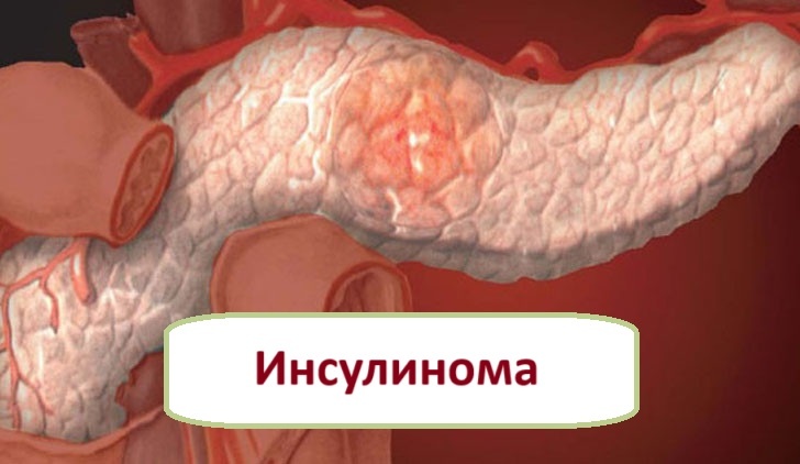 Сахар - падает, инсулин - поднимается...
