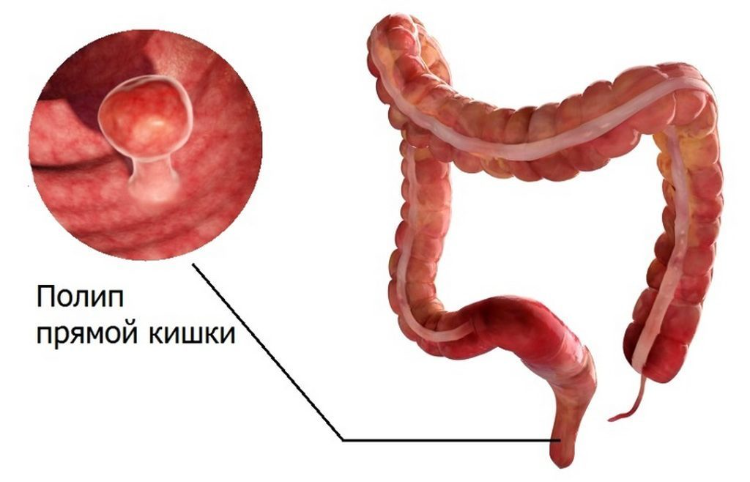 Эти 7 основных факторов риска провоцируют опасные полипы кишки, которые могут привести к раку