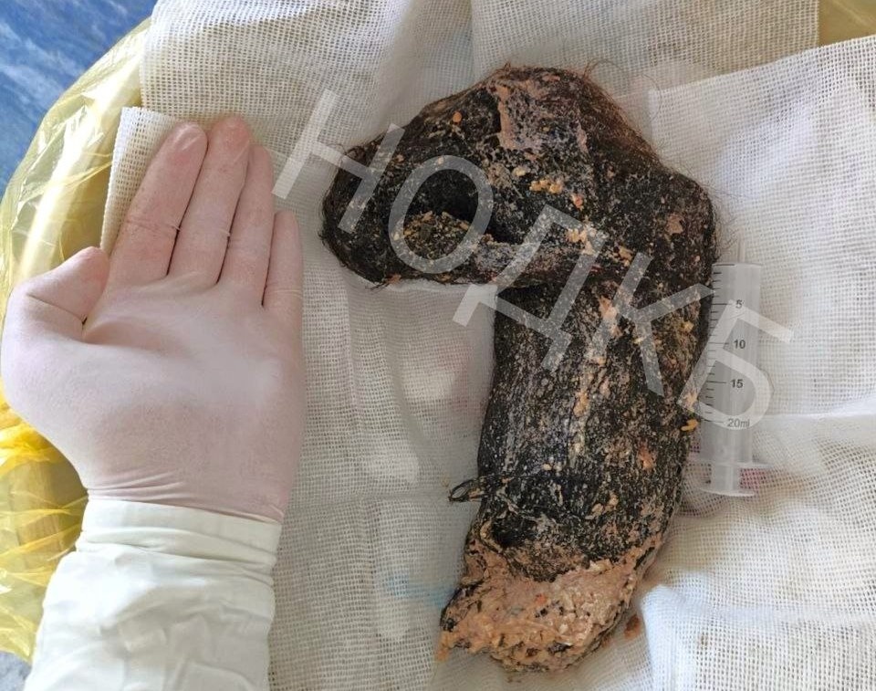    В медицине это состояние известно как синдром Рапунцель