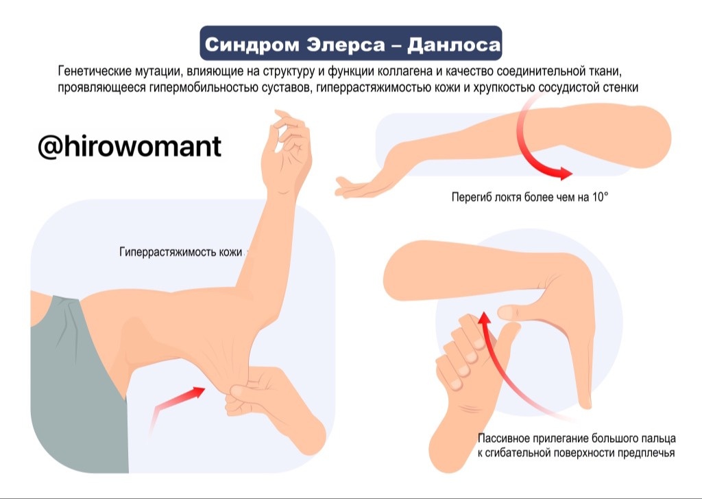 Синдром Элерса-Данло