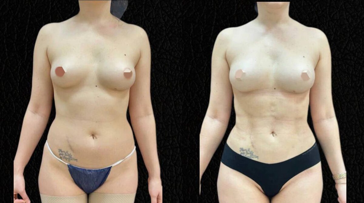 Выполнили липосакцию, липомоделирование и липофилинг молочных желез  (1 месяц после операции)