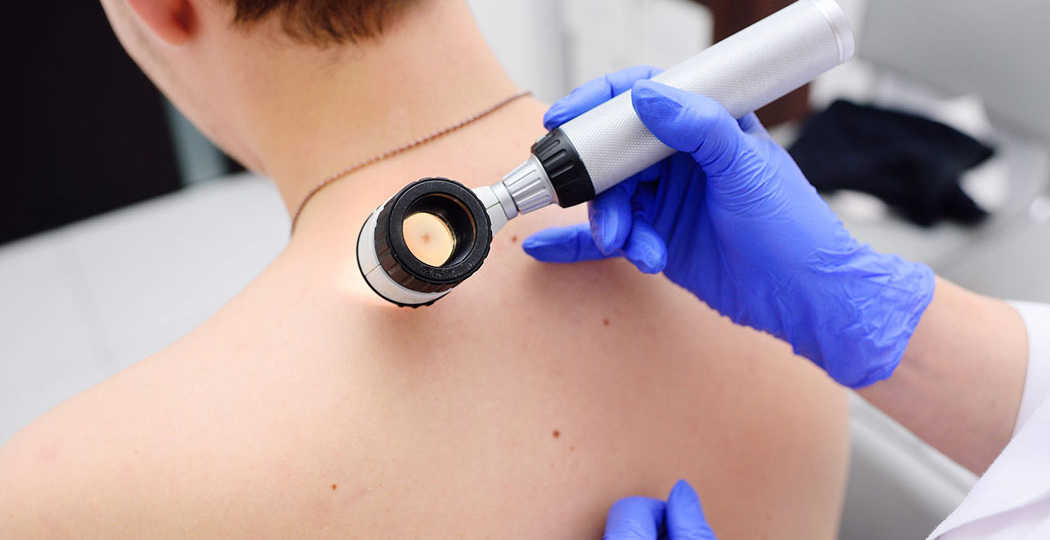 Меланома или пигментные пятна? Как отличить