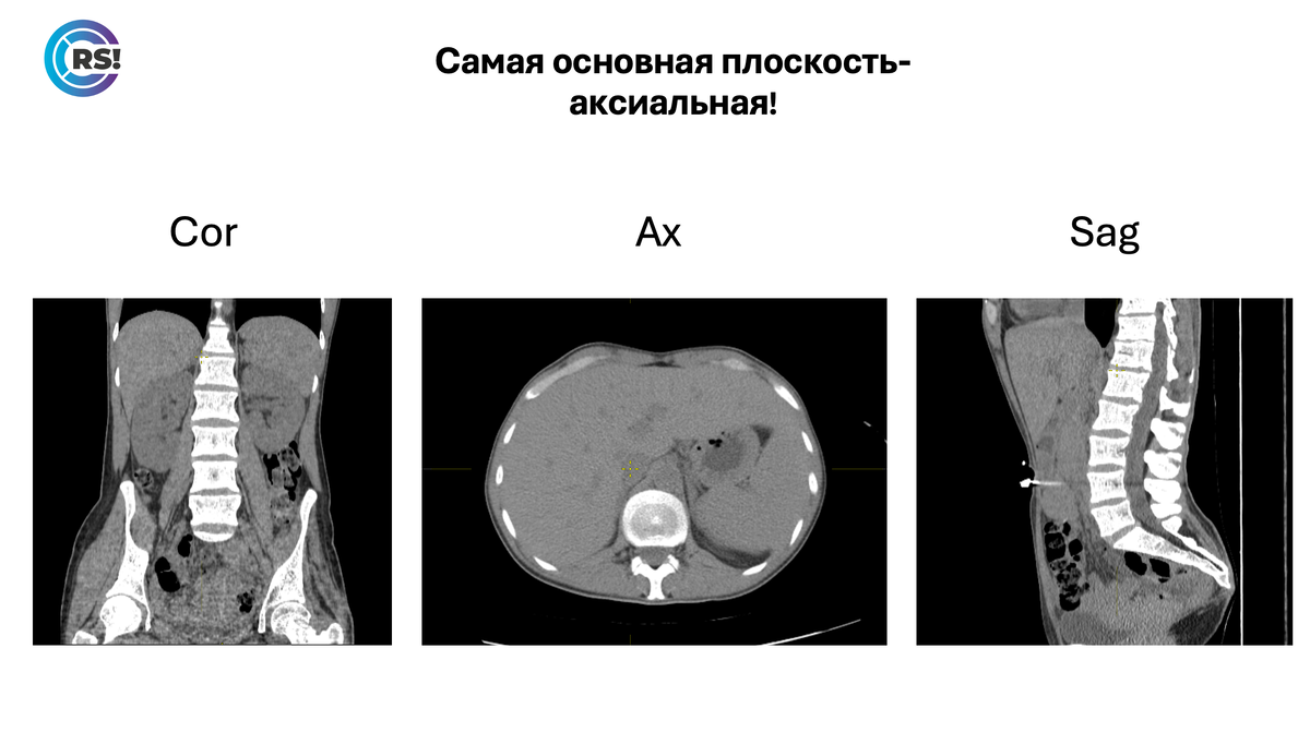 Коронарный, аксиальный и сагиттальный срезы брюшной полости. 