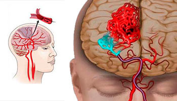 Инсульт - это острое нарушение кровообращения мозга, приводящее к повреждению и отмиранию нервных клеток.
       Происходит это из-за разрыва кровеносного сосуда в мозге или его закупорки бляшкой или тромбом. При этом кровь перестает поступать в определенную часть мозга, и в результате находящиеся там нервные клетки не получают необходимого им кислорода. Инсульт - самое опасное заболевание сосудов головного мозга, возглавляющее мировой список причин в по смерти. Патология сопровождается острым нарушением мозгового кровообращения, поражением сосудов и ЦНС. При нарушении нормального кровотока ухудшается питание нервных клеток головного мозга, Происходит это из-за разрыва кровеносного сосуда в мозге или его закупорки бляшкой или тромбом. При этом кровь перестает поступать в определенную часть мозга, и в результате находящиеся там нервные клетки не получают необходимого им кислорода.