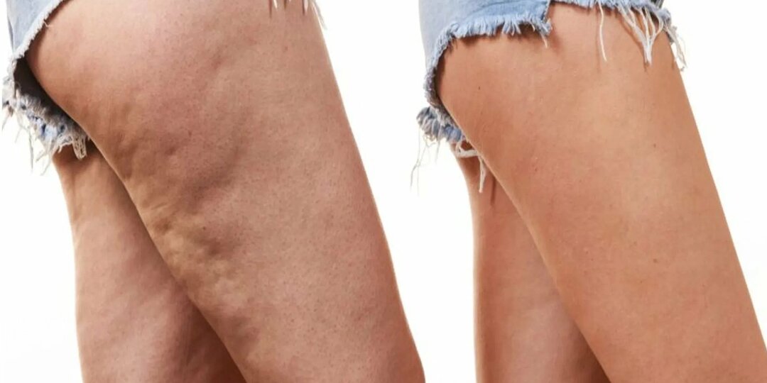 Вот что происходит, когда в организме не хватает белка: сигналы, на которые стоит обратить внимание