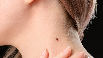 Клещи выбирают для укуса тёплые участки с тонкой и нежной кожей — там, где близко расположены кровеносные сосуды