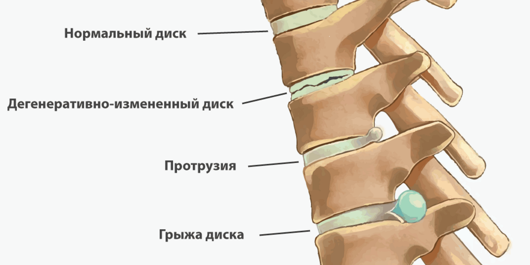Протрузия, грыжа, защемление: как отличить и не запутаться в симптомах?