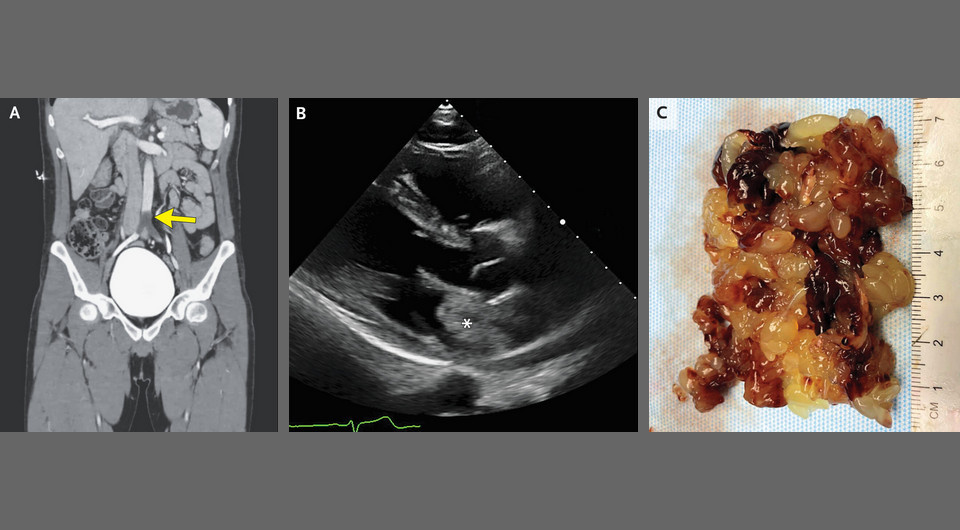   Chirag A. Buch, and Nilam J. Soni / NEJM, 2025