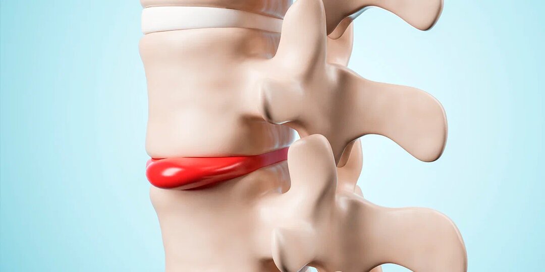Межпозвоночная грыжа: как снять боль, вылечить и укрепить спину