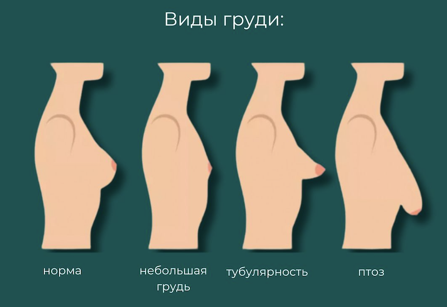 Виды груди