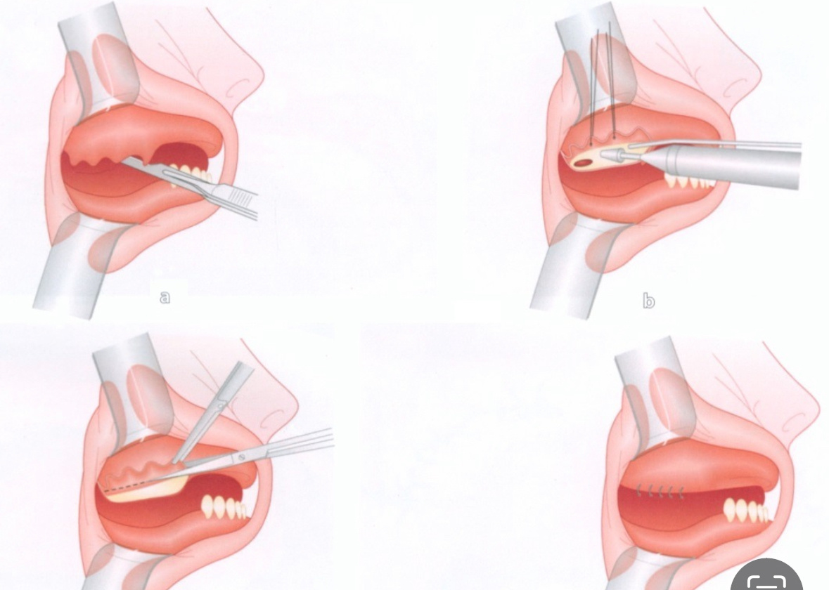 Пример редукции части альвеолярного гребня 