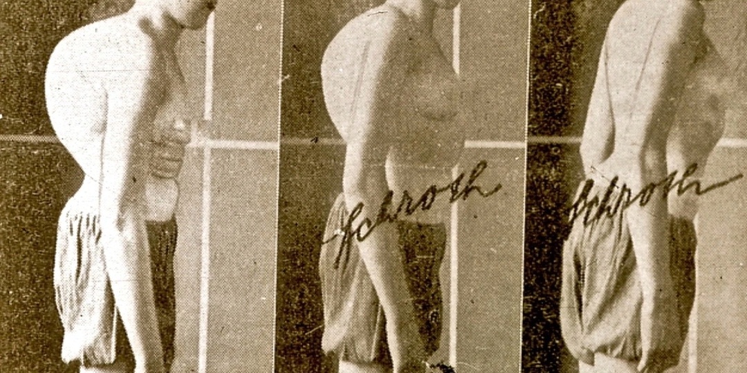 ИСТОРИЯ МЕТОДА 3D КОРРЕКЦИИ СКОЛИОЗА ШРОТ-ТЕРАПИИ