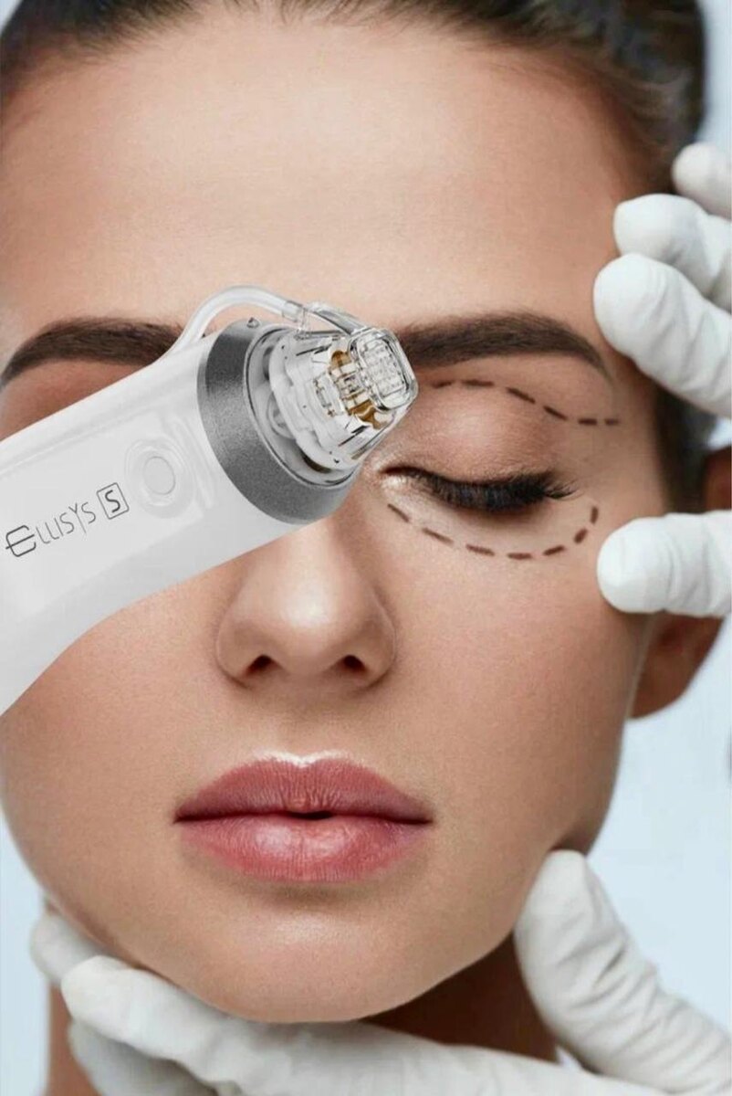RF-лифтинг Sense Kiss - насадка для обработки области вокруг глаз на аппарате Ellisys Sense