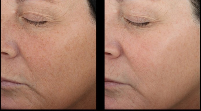 До и через 16 недель, женщине 59 лет. 