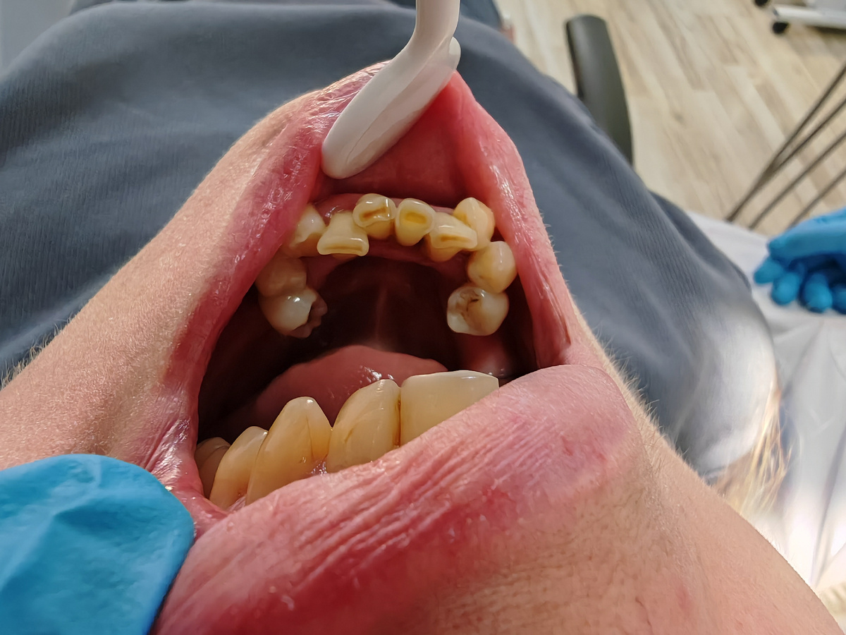 До протезирования. 