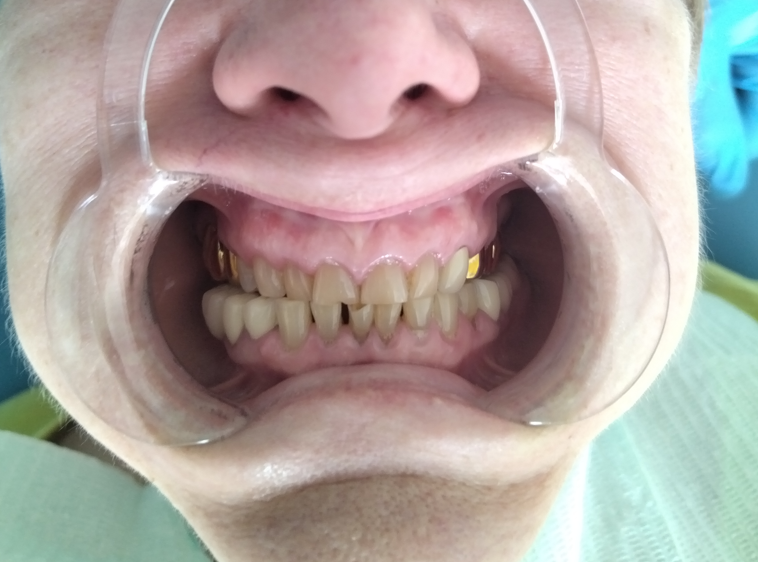 До протезирования. 