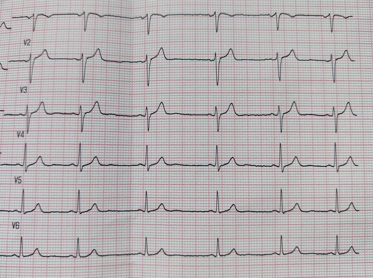 Другой пациент. Минимальная ЧСС 47 уд в мин, а максимальная - 60 уд в мин. 