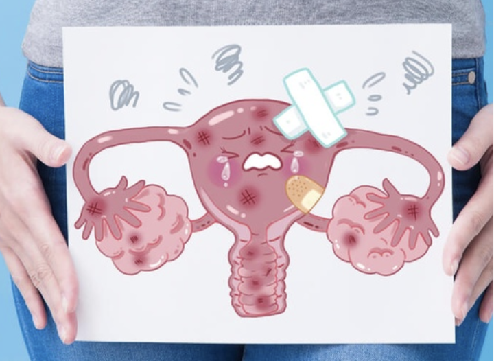 Нужно ли удалять кисту яичника?