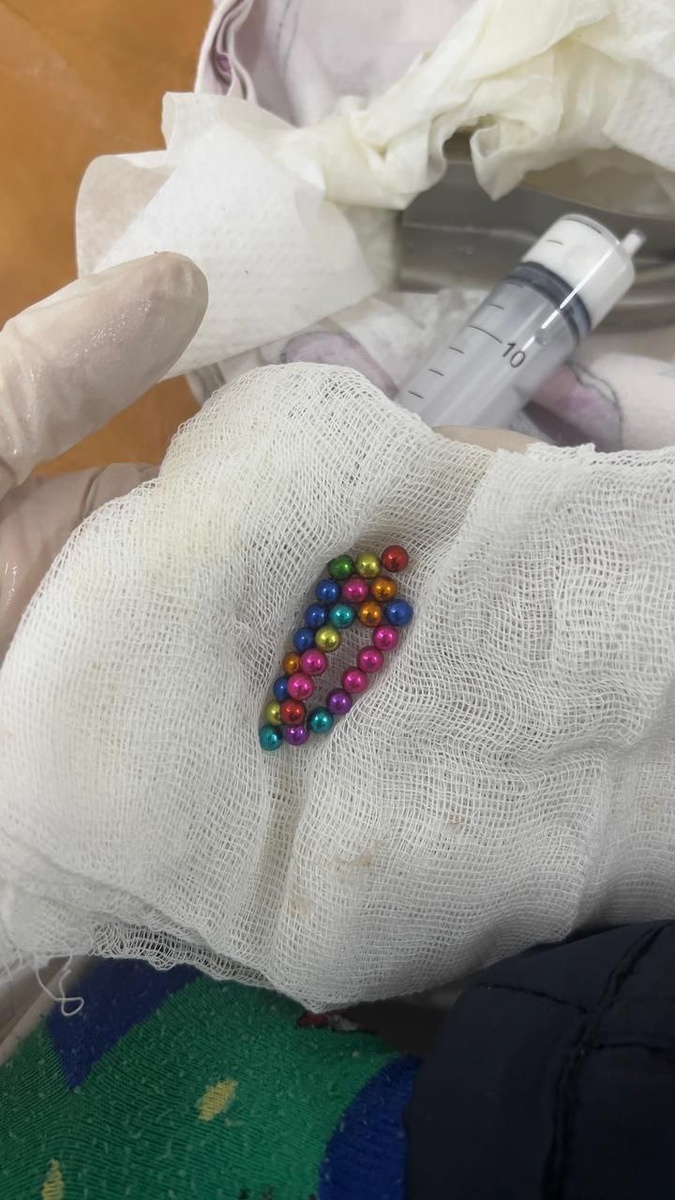 Вот такая "красота" попала в желудок мальчика