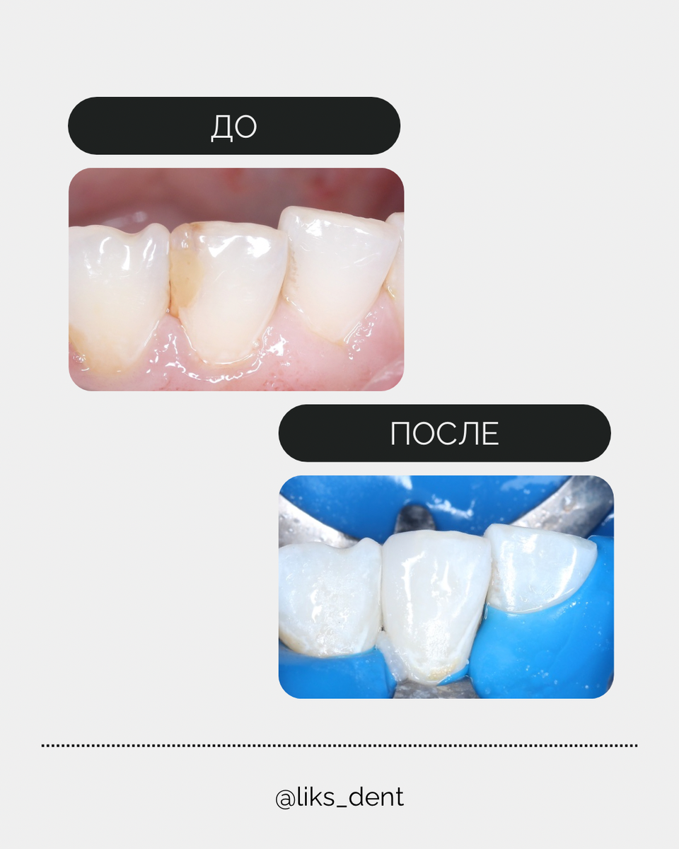 до/после лечение кариеса