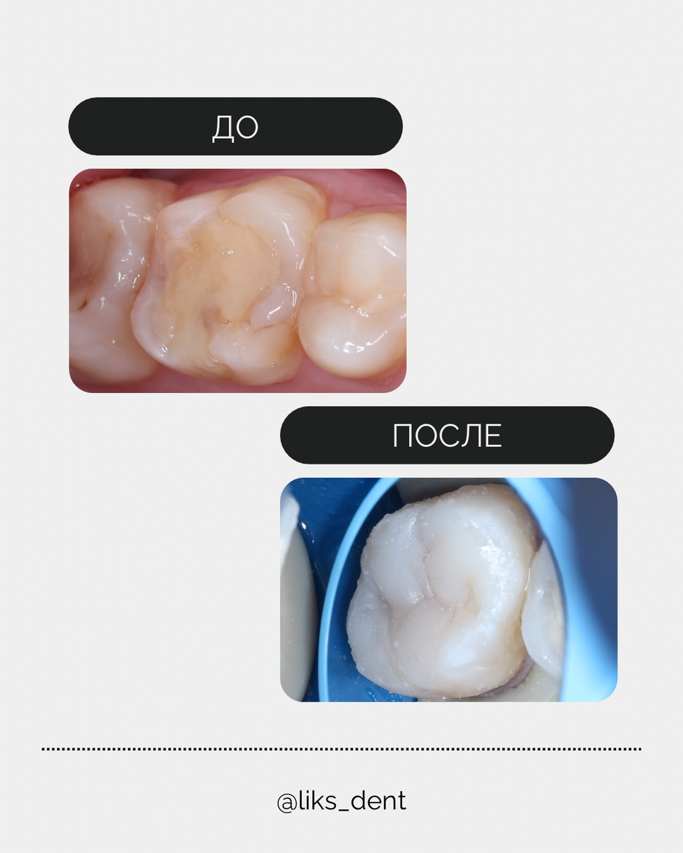 до/после лечение кариеса