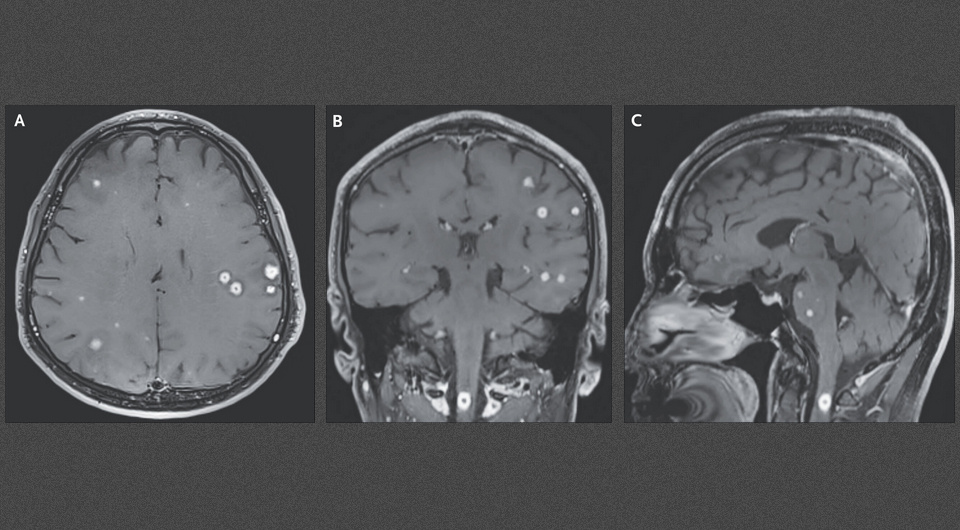   In-Suk Bae, Yung Ki Park / NEJM, 2025