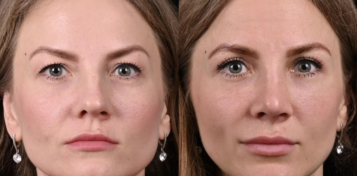 Устранили излишки кожи на верхнем веке и по желанию пациентки выполнили липофилинг носослезной борозды. Фото до и после. Фото с сайта хирурга Д.Р. Гришкяна. Имеются противопоказания, требуется консультация специалиста