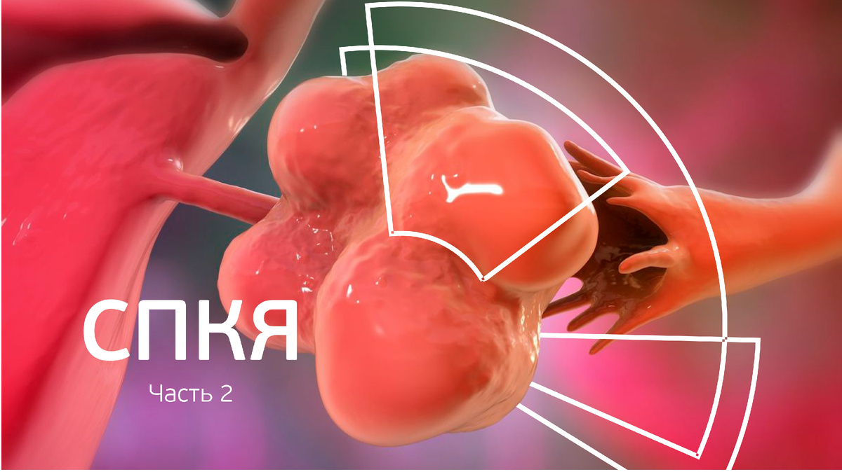 Синдром поликистозных яичников: как лечится и профилактика заболевания