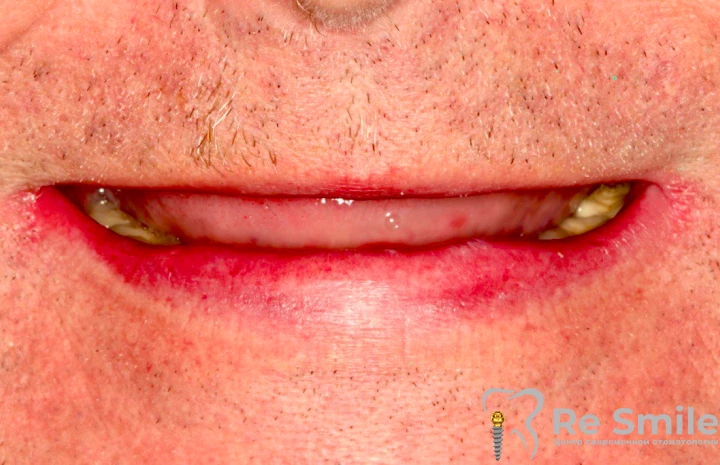 Пациент обратился в клинику с жалобами на отсутствие зубов на верхней челюсти. В анамнезе были абсолютные противопоказания к имплантации.