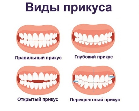 Изменения прикуса