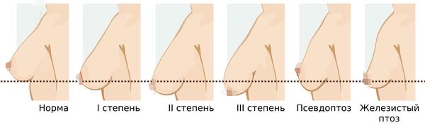 Птоз молочных желез. Источник: https://probolezny.ru/ptoz-molochnyh-zhelez/