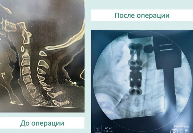    Подросток в Кирове вернул подвижность после сложной операции