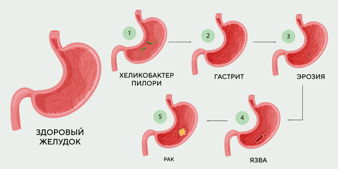 ПЕРВЫЕ СИМПТОМЫ ГАСТРИТА, которые нельзя игнорировать