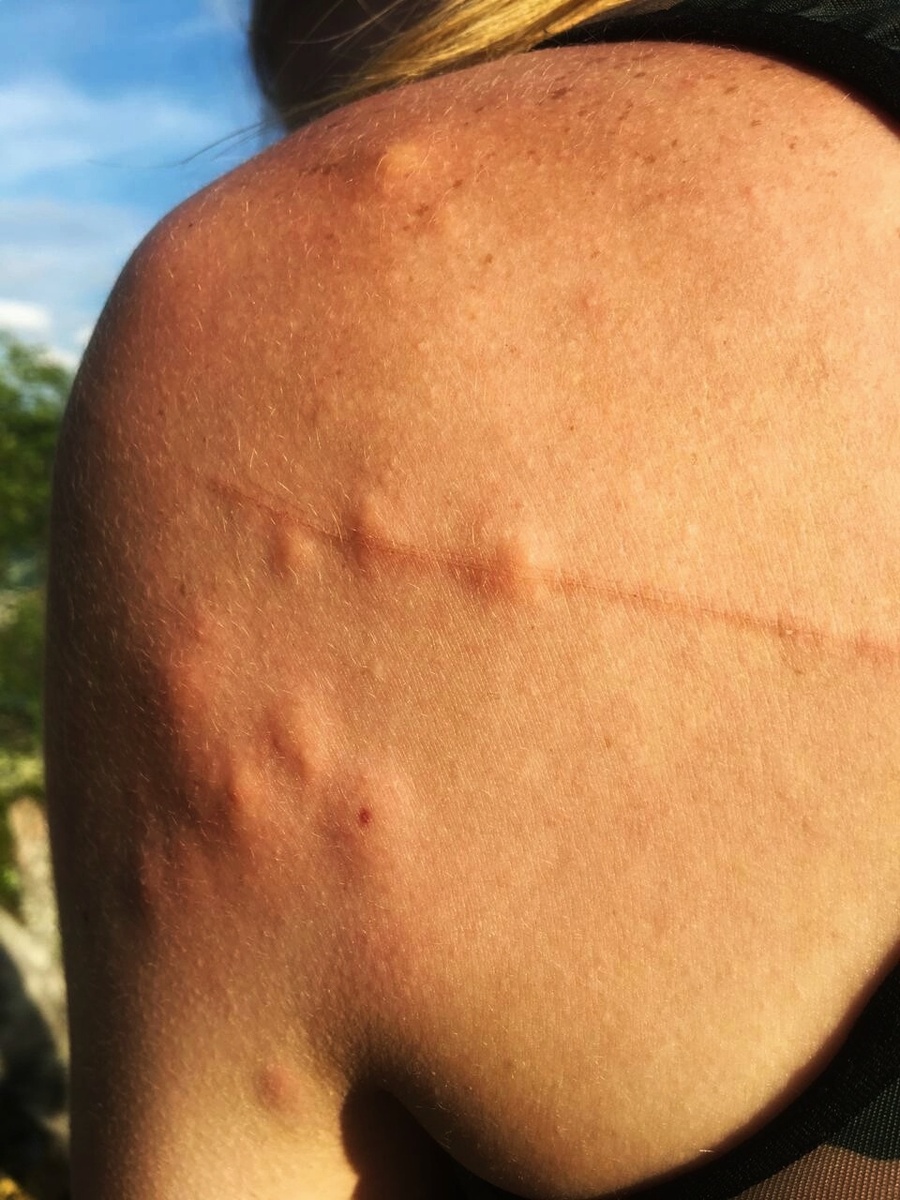 Мошка - не комар. Она выгрызает часть плоти, и потом всё это долго заживает. 