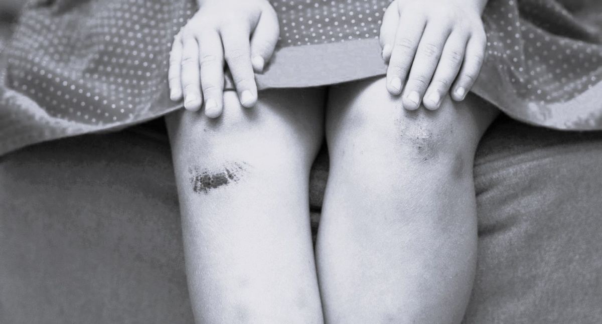 Ссадины на коленках.