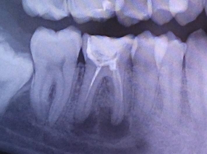 Киста корней зуба