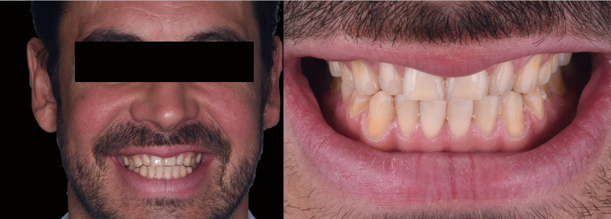 Рисунок 1. Исходное состояние пациента: Фоторегистрация лица и улыбки.