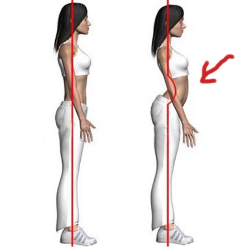Правильная осанка и гиперлордоз