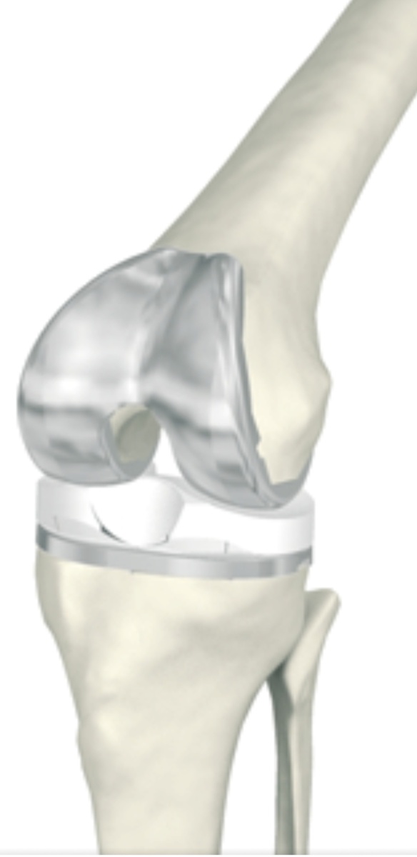 Эндопротез коленного сустава.Фото с интернета.