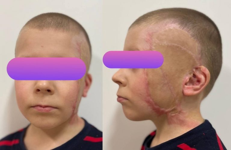    Столичные врачи спасли лицо ребёнка из Оренбуржья, которого переехал трактор Оренбуржье