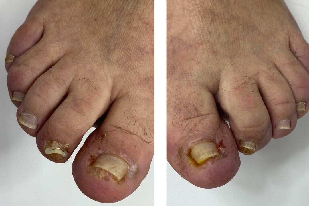 После 3 разового применения "противогрибковых капель из аптеки"