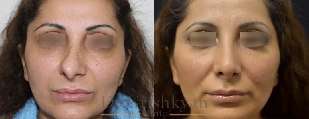 Пример неудачной ринопластики, явная асимметрия. На фото справа - результат коррекции. Фото с сайта Д.Р. Гришкяна. Имеются противопоказания, требуется консультация специалиста